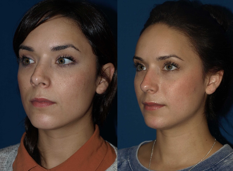 Revision Rhinoplasty Before And After Photos