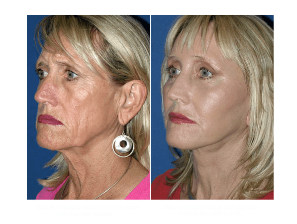 Non Surgical Cheekbone Contouring North County San Diego, San Marcos &  Menifee