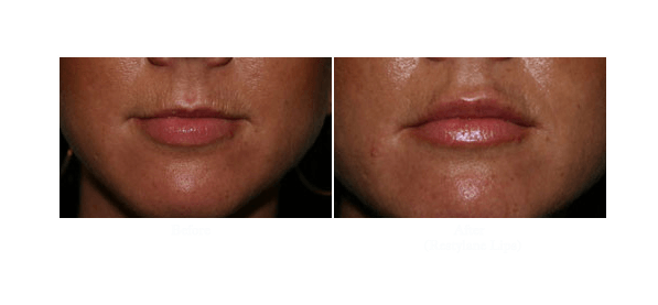 Lip Augmentation San Diego | Lip Enhancement San Diego