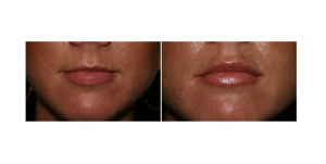 lip injections san diego