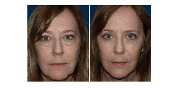 What is the recovery time after eyelid surgery?