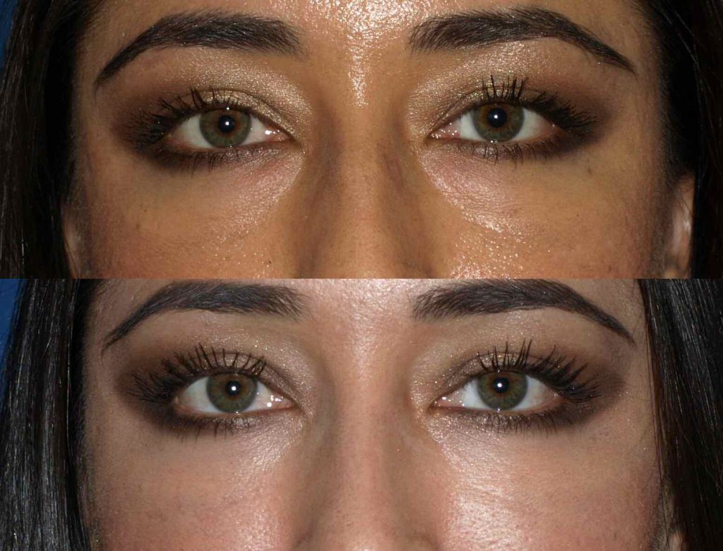 eyes before and after vertical - Golden Triangle Plastic Surgery