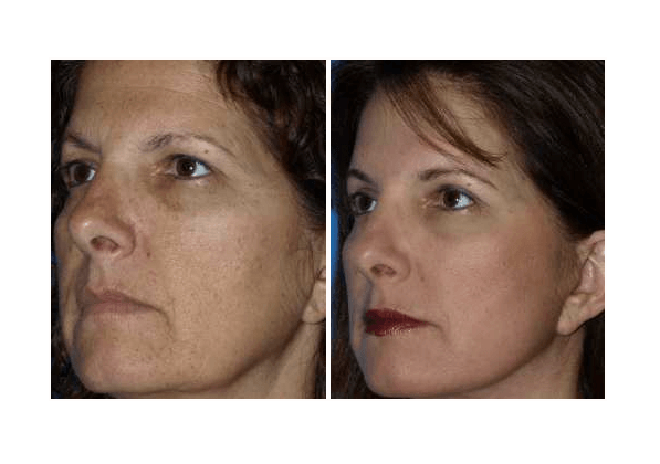 resurfacing skin laser options facelift surgeon plastic sandiegoface deeper