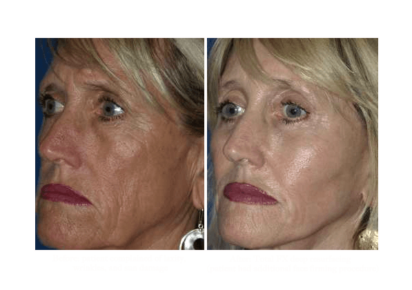 Laser Resurfacing – UltraPulse Fractional CO2