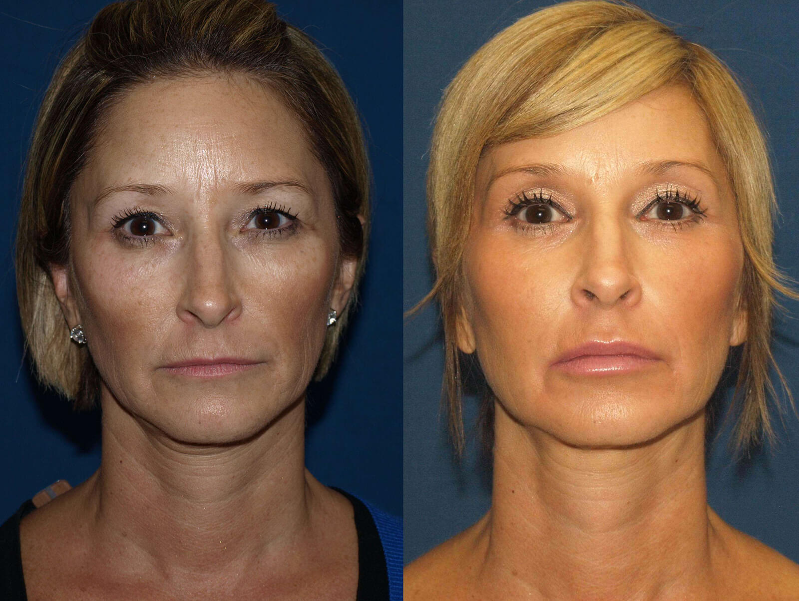 Liquid Facelift San Diego | Facial Filler Facelift San Diego