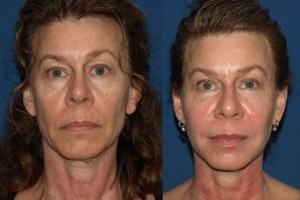 Facial Fat Grafting Facelift offers Cost-Effective and Non-Invasive  Solution to Facelift