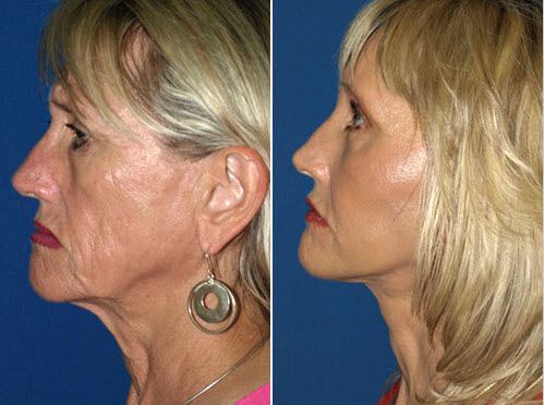 Orange County Facial Rejuvenation Surgery