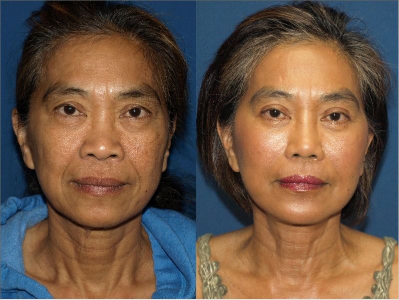 Ethnic Rhinoplasty Before and After - Head and Neck Surgeon