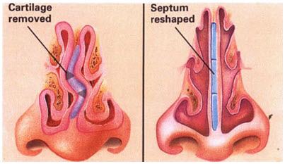 Difficulty breathing deals through nose