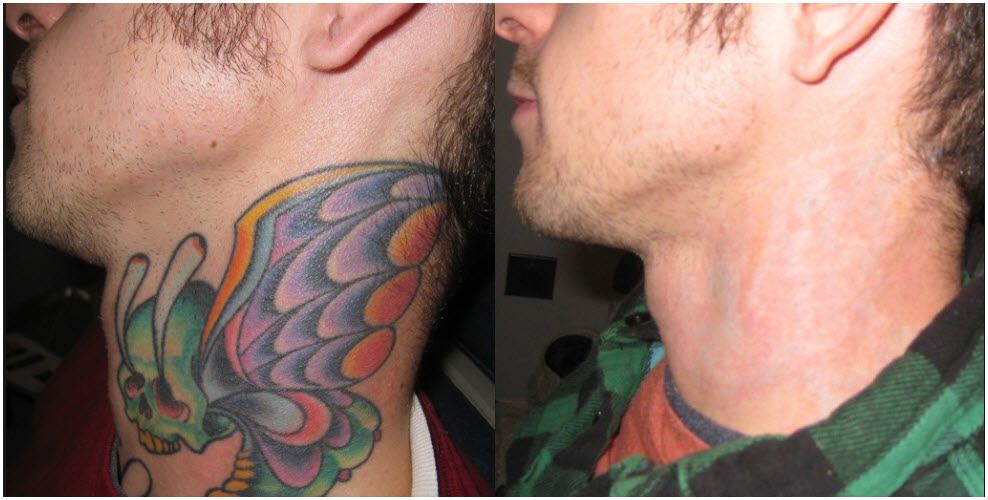 Laser Tattoo and Birthmark Removal Cost in Ludhiana Punjab India