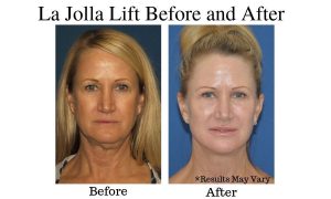 Before and after for Dr. David's La Jolla Lift patient in San Diego, California.